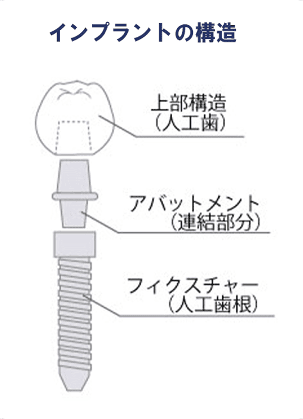 インプラントの構造