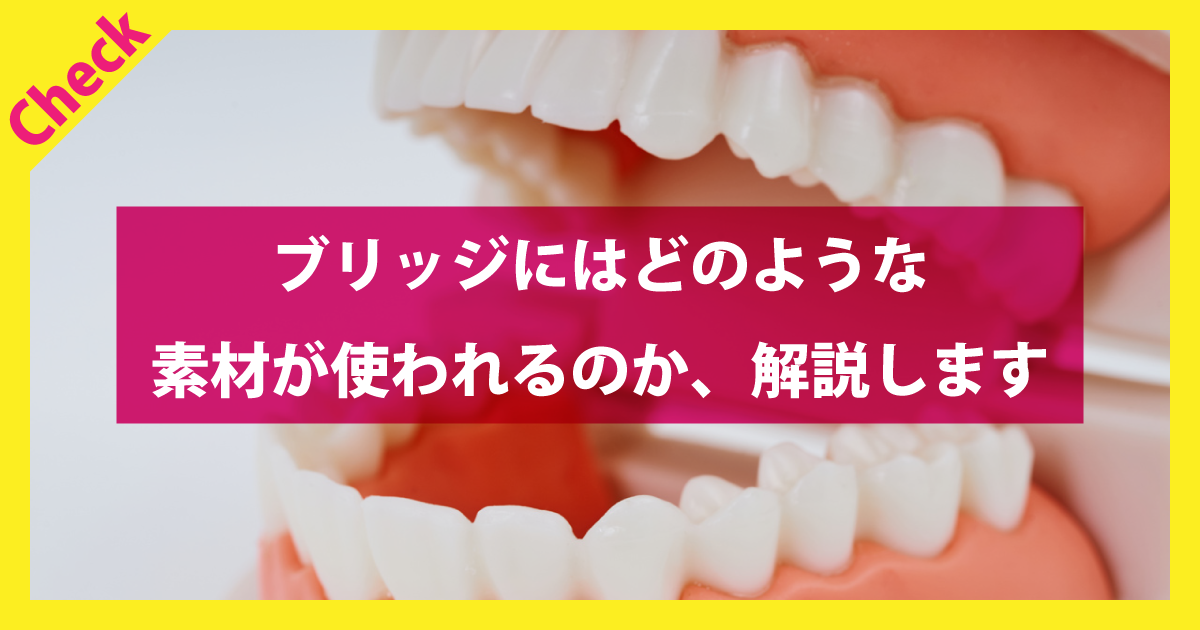 ブリッジにはどのような素材が使われるのか、解説します | 五反田駅